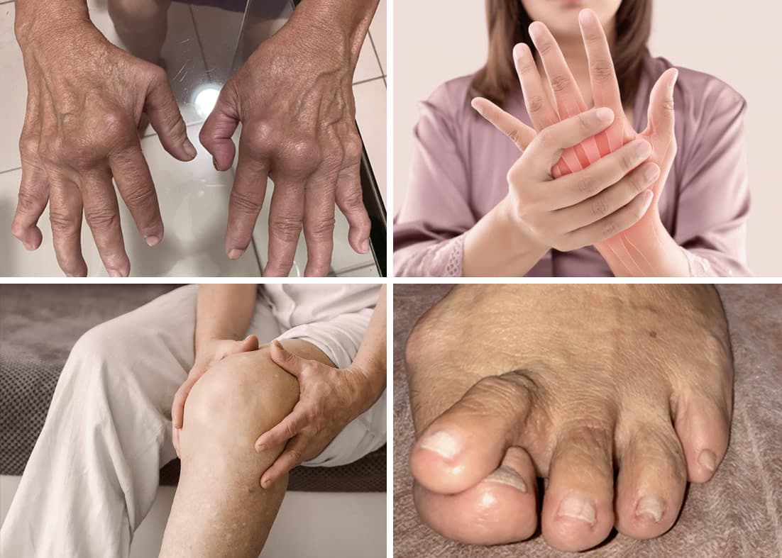 Imagem ilustrativa sobre Artrite reumatoide na reumatologia