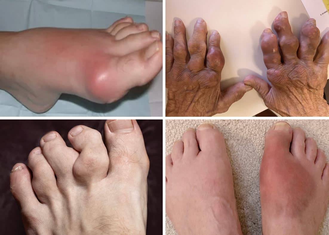 Imagem ilustrativa sobre Gota na reumatologia