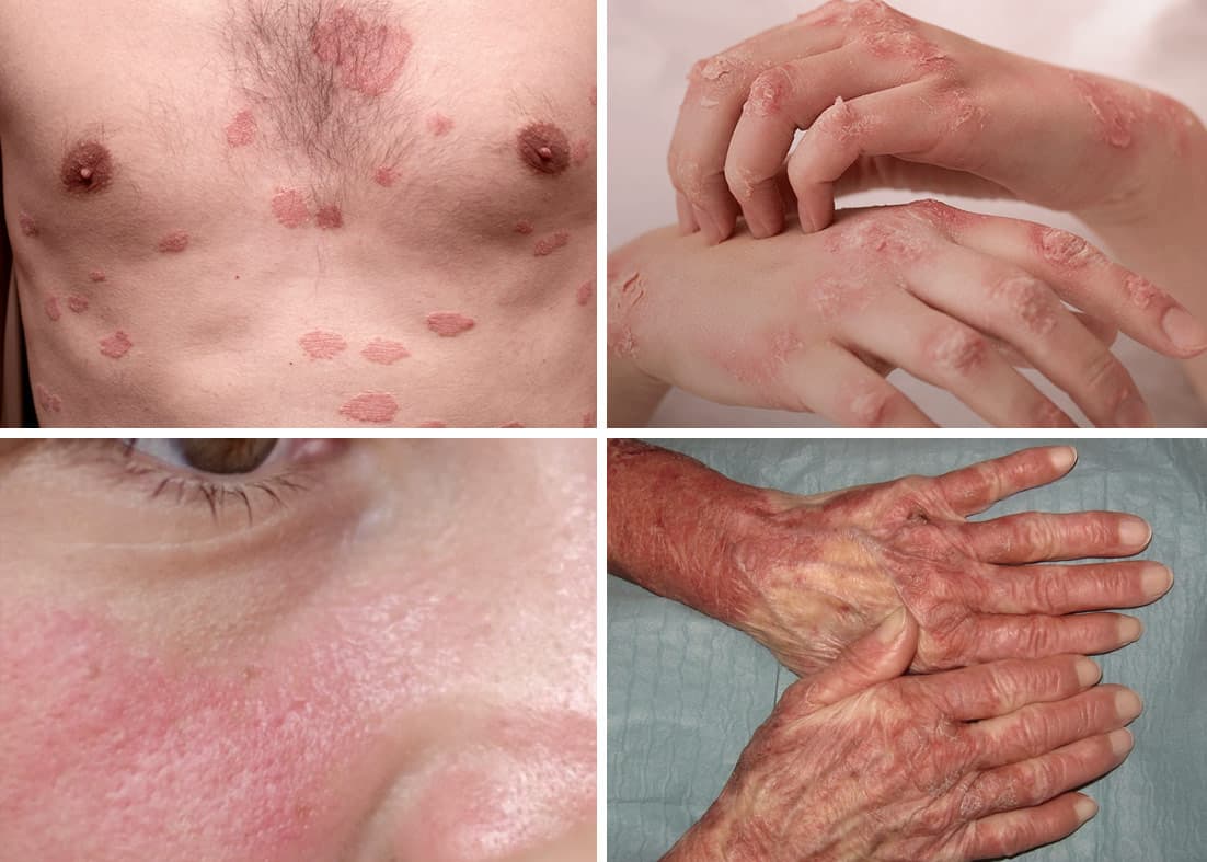 Imagem ilustrativa sobre Lúpus eritematoso sistêmico (LES) na reumatologia